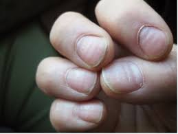 Image result for Beau lines feet