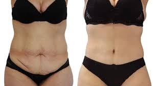 Le prix de la chirurgie du ventre dépend de la complexité de. Abdominoplastie Ou Plastie Abdominale Paris Vincennes Dr Bouhanna