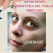 ¿TIENES OJERAS? 🐼, La hipercromía idiopática del anillo orbitario,  conocida como #ojeras, o círculos negros debajo los ojos son alteraciones  de la coloración de la piel debido a una producción ...