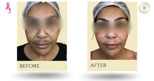 Melasma doesn't fade easily, but with the right plan, it can be managed  beautifully., Angela Abrahams began her journey to clearer, more even-toned  skin after struggling with persistent Melasma, one ...