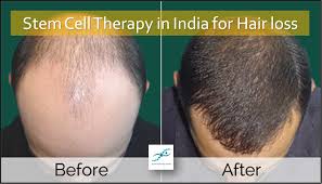 Hair regrowth treatment works on stem cell therapy which involves replenishment of the lost stem cells. Affordable Stem Cell Therapy For Hair Loss In India Stem Cell Therapy In India Blog