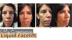 Sign up for more info. Best Botox Specials Near Me New Jersey Botox Cosmetic Price Cost