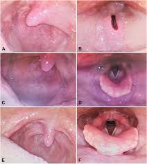 Image result for Angioedema