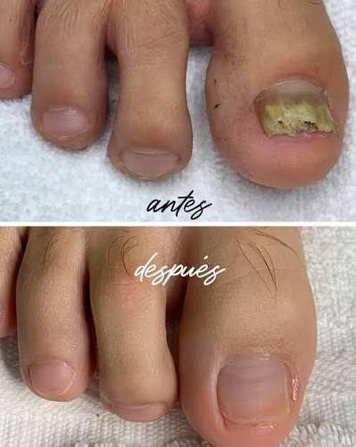 Conoce el antes y después del tratamiento de Onicomicosis (hongos en las  uñas). Haz tu cita llamando o escribiendo por Whatsapp: 📍Carrretera a El  Salvador 📞6633-9960 / Whatsapp: 5120-6414 📍San Isidro Zona