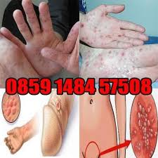 Selalunya, disebabkan kepercayaan salah bahawa simptom semacam itu adalah selesema biasa. Tanda Gejala Sipilis Pada Wanita Gejala Sipilis Ciri Ciri Sipilis Sipilis Pria Penyakit Sipilis Obat Sipilis