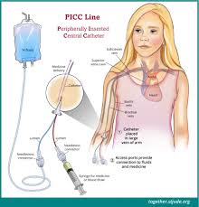 A picc line may be used because: Picc Line For Childhood Cancer Patients Together