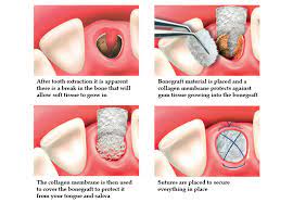Bone Grafting Is Usually A Relatively Comfortable Office Procedure During This Procedure The Membrane That Lines Bone Grafting Grafting Dental Assistant Jobs