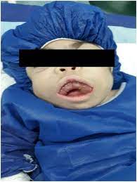 The Oral And Maxillofacial Manifestation And Surgical Consideration In Maroteaux Lamy Syndrome Mucopolysaccharidosis Vi A Case Report