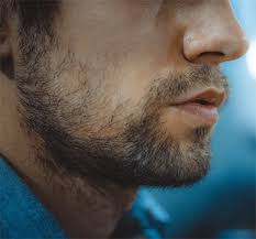 One of the hallmark features of polycystic ovary syndrome is a higher than normal level of androgen hormones. Does Dht Cause Facial Hair Loss Of The Beard And Moustache
