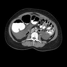 Free Fluid In Follicular Study: Is It Normal? 11 Causes Explained