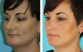 Pin On Rhinoplasty
