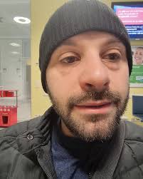 Buongiorno Famiglia mia! Stamattina una bella sorpresa🤒! Faccia gonfia e  naso gonfio lato destro compreso l occhio e devo dire che ho pensato al  peggio e perciò sono passato un attimo in