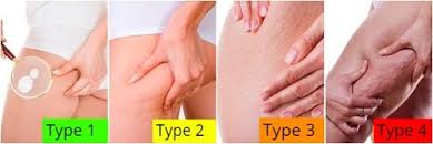 La cellulite ou lipodystrophie superficielle est une disgrâce esthétique qui sollicite un amas de. Comment Enlever La Cellulite Naturellement C 2021
