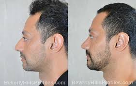 If you want to try out the curls look you can go for gatsby glam. Rhinoplasty Before After Photos Beverly Hills La Rhinoplasty