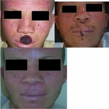 Oculocutaneous Albinism. Pre-excision of squamous cell carcinoma (SCC)...