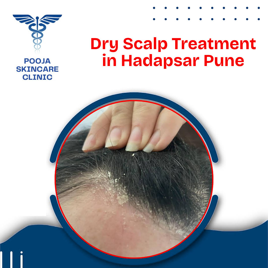 Dry Scalp Treatment in Hadapsar Pune product image