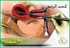 تنظيف الرحم عملية التنظيف بعد الاجهاض بالصور