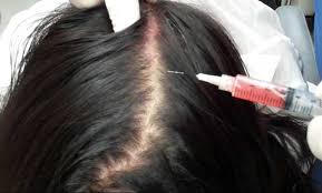 Hair growth results after mesotherapy hair loss treatment may differ from patient to patient, as some of the patients reported results just after their first session, though the usual time expected to show results after mesotherapy treatment is fourth to the fifth session. Mesotherapy Treatment For Hair Growth Vardaan Clinic