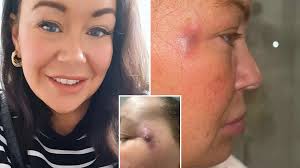 Giant crusty boils that oozed pus and blood erupted across woman's face  after £60 anti-wrinkle jabs