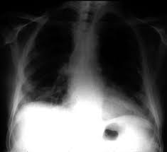 Aerob bedeutet sauerstoffabhängig oder sauerstoff verbrauchend. Invasive Aspergillose Unterstutzung Fur Aspergillose Patienten Und Betreuer Durch Das Nhs National Aspergillosis Centre Uk