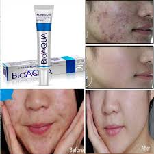 Oshi Pk Is Bringing A Bio Aqua Acne Removal Cream In Such Low Reasonable And Affordable Price Which You Can 39 Face Cream Acne Scar Removal Cream Remove Acne