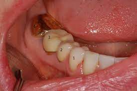 8 tips for healthy teeth. How Long Does A Dental Crown Last Bauer Smiles