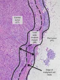 Resection margins are the area around a section of tissue removed during surgery to treat a tumor. The Invasive Margin Im Is Defined As The Region Centered On The Download Scientific Diagram