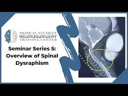 Image result for Spinal Dysraphism