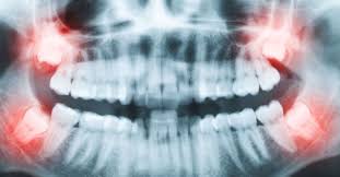 But, for example, this clause might exclude the removal of asymptomatic wisdom teeth or teeth taken out how come pulling little teeth cost as much as back molars? Symptoms And Causes Of Wisdom Teeth Issues Nsoms Oral Maxillofacial Surgeons