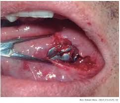Gunshot wounds that pass through the body without hitting major organs, blood vessels, or bone tend to cause less damage. Gunshot Caused Facial Wound Literature Review And Clinical Study Of Three Cases Revista Odontologica Mexicana