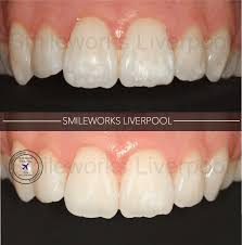 White Marks On Teeth How To Remove Them Price Review Pictures