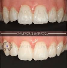 Instead, use a white cloth or tissue paper and dab carefully on the stained area. White Marks On Teeth How To Remove Them Price Review Pictures