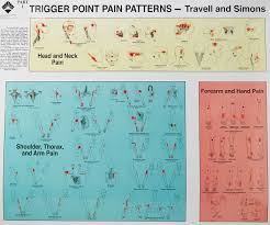 Trigger Point Injections Trigger Point Injection Technique