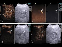While orange or brownish urine can have a multitude of causes, liver disease must be ruled out. Microbubbles Enhance Response To Tare In Liver Cancer 2020 12 18 Bioworld