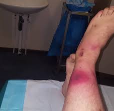 Symptoms Of Flesh Eating Bacteria Singapore Toddler Infected By Flesh Eating Bacteria Theasianparent
