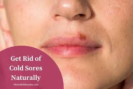 Cold Sore Remedies