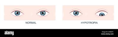 Image result for Eye Deviation