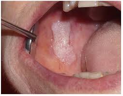 Image result for spinocellular carcinoma of the oral cavity