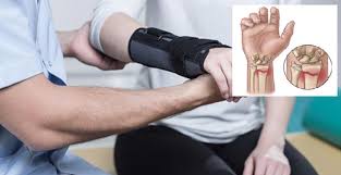 نتیجه تصویری برای شکستگی های مچ دست