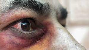 Hongo negro en la piel. Covid Guatemala Registra Primera Muerte Por El Hongo Negro Anf Agencia De Noticias Fides