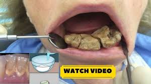 How to remove a tooth at home. Removing Plaque From Teeth Naturally Teethwalls