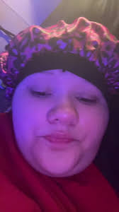 Randy Roofer Broken Leg