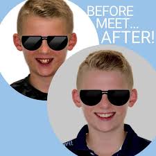 Cross bite fixed with Taree Invisalign