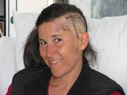 Glioblastoma Brain Tumor Survivor