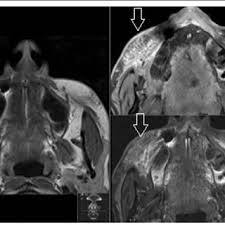 This type of detector does a good job in detecting flames, but one drawback is that it's. Pdf Mri In Detecting Facial Cosmetic Injectable Fillers
