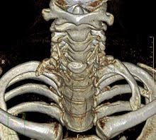 Reine charting the hololiveid gen 2. Cervical Rib Wikipedia
