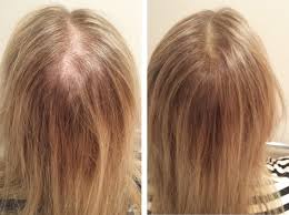 However, avoid consuming green tea in excess and stick to one or two cups a day. How To Get Regrow Hair Naturally