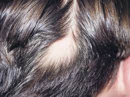 Batra's clinic and this has made me write a review on my experience with dr. Dr Batra Hair Loss Treatment Reviewmouthshut
