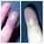 When To Drain A Smashed Finger