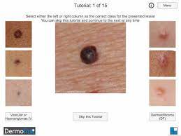 If you spot any signs of another skin cancer between check ups, you should contact your gp or specialist. Cancer Detection Apps Stage Skin Cancer